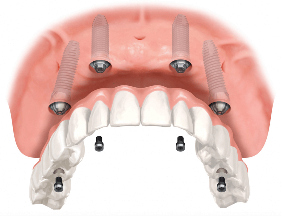 Full Arch with Only 4 Implants